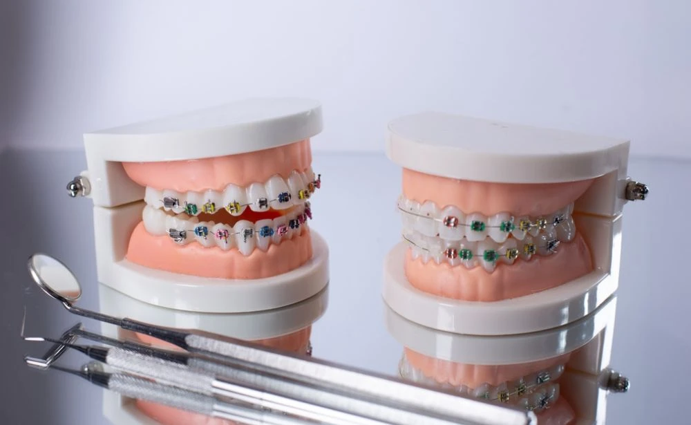 Ortodonti Tedavisi Ne Kadar Sürer? Sakarya'da Diş Teli Hakkında Merak Edilenler